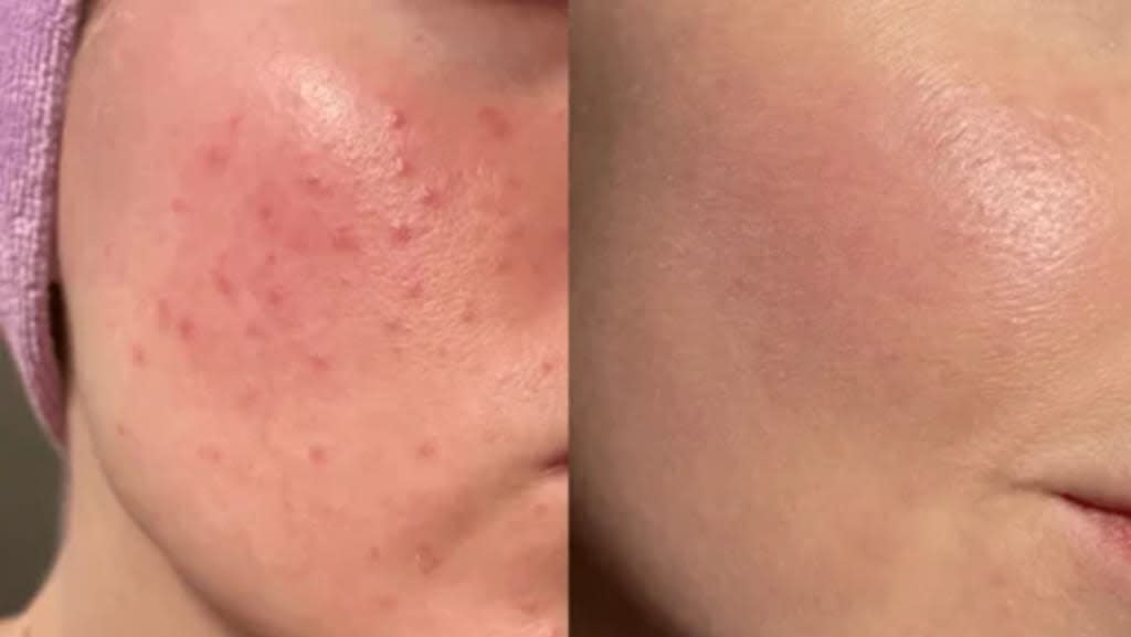 Vivatra Exfoliating Gel