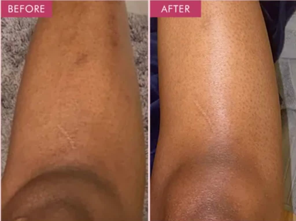 Vivatra Exfoliating Gel